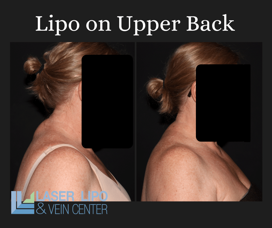 Liposuction Before & After (5)