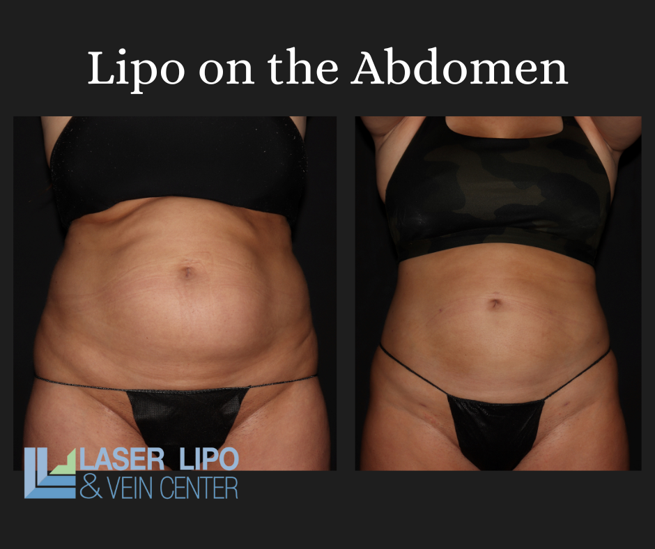 Liposuction Before & After