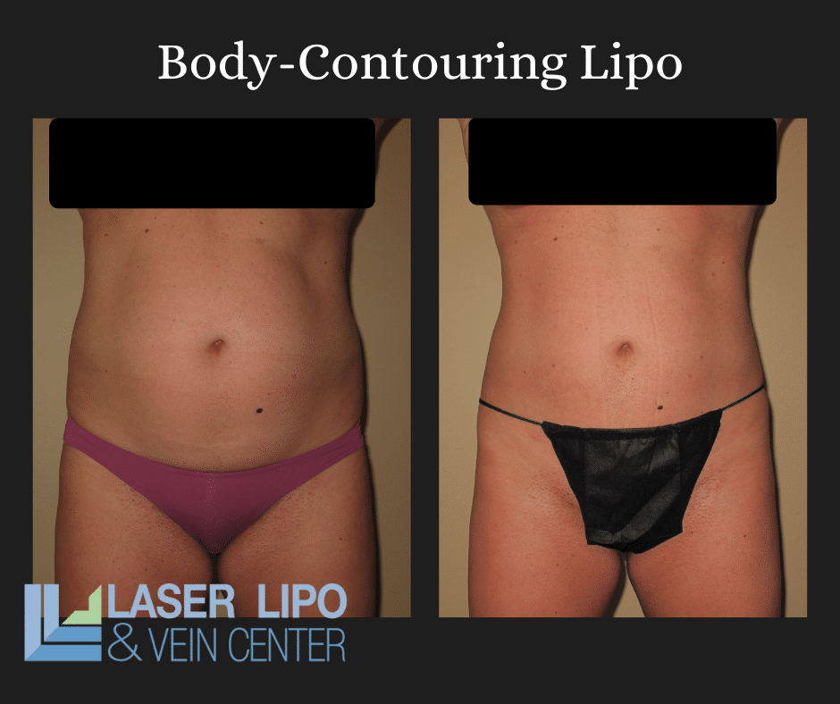 Renuvion & Lipo Before and After (1)