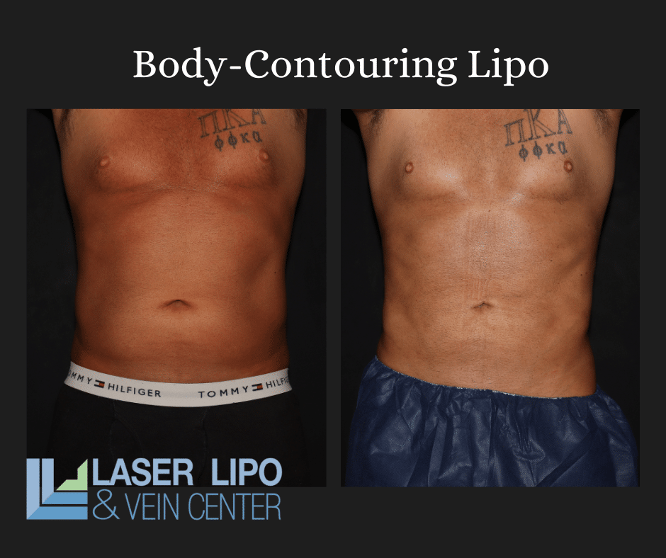 Renuvion & Lipo Before and After