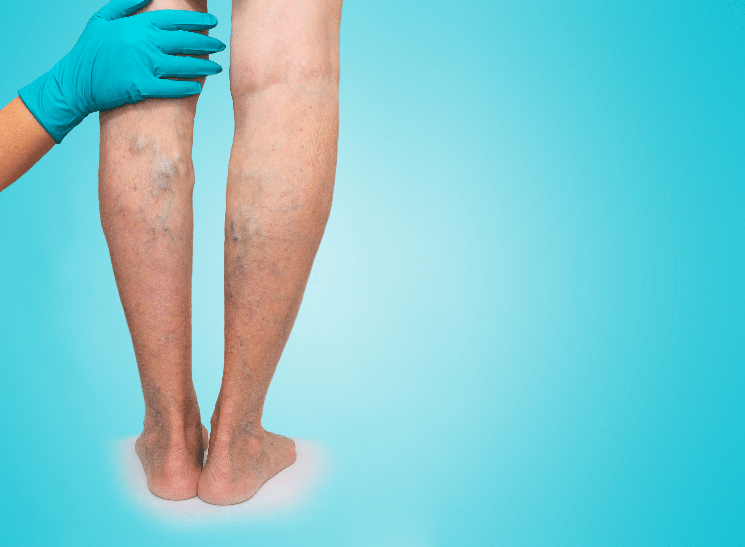 Sclerotherapy Vein Treatment St Louis
