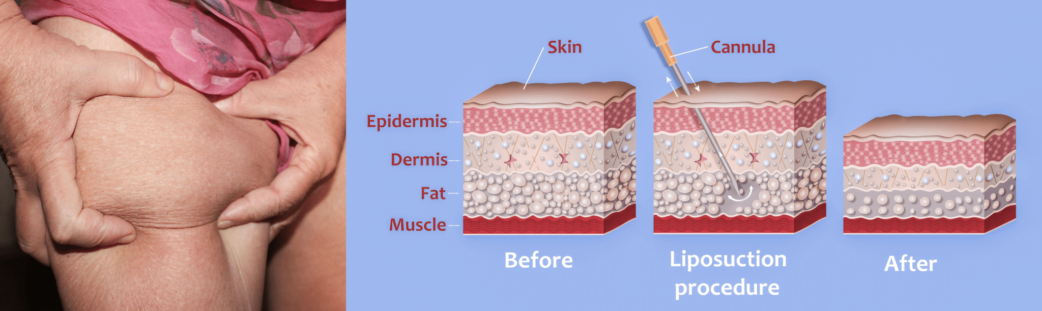 Ultimate Guide to Liposuction Treatments | St Louis Lipo