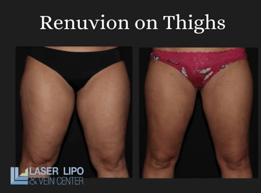 Renuvion JPlasma Skin Tightening St Louis