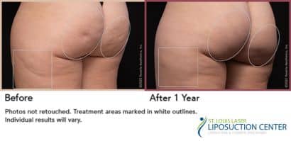 Aveli cellulite st louis laser liposuction center 1