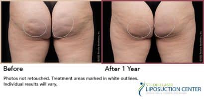 Aveli cellulite st louis laser liposuction center 2
