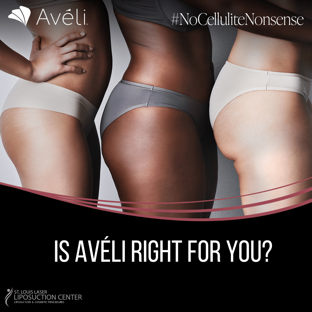 Aveli St Louis Lipo Dr WRight Cellulite Treatment