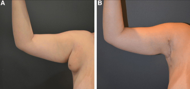 Axilliary Breast Tissue Removal
