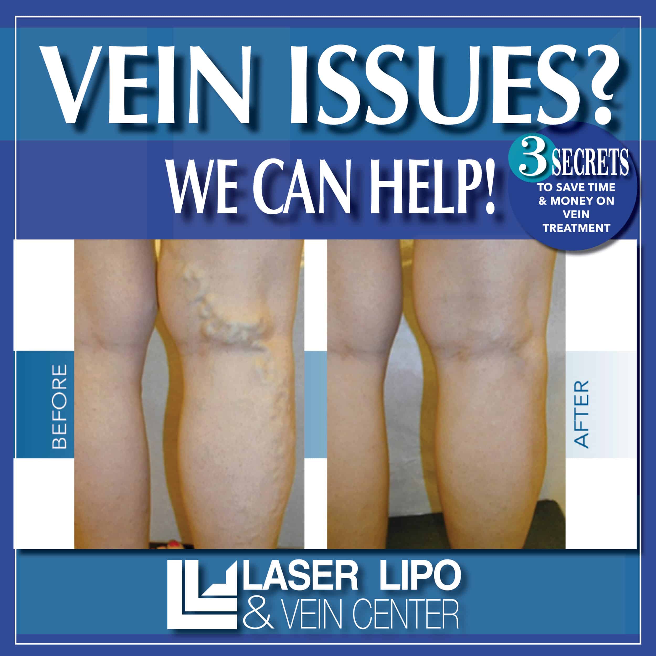 LLVC 2024 1 January Vein Treatment 800x800 3 SECRETS