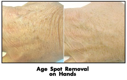 age spot removal