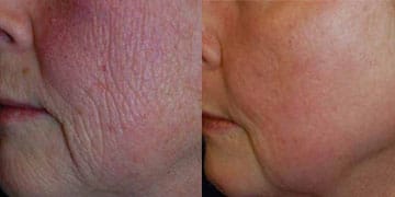 before and after peel