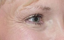 botox 01 before