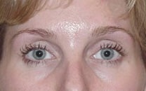 botox 03 after