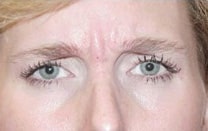 botox 03 before