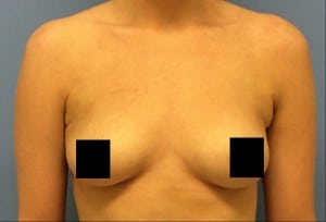 female axillary arm liposuction after