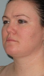female chin liposcution after