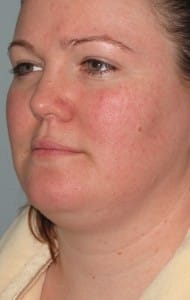 female chin liposuction before
