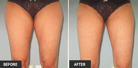 female inner thigh liposuction before and after 1