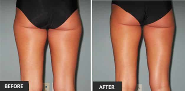 female inner thigh liposuction before and after 3