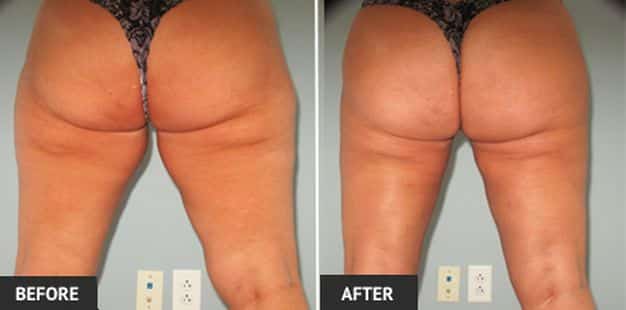 female inner thigh liposuction before and after 4