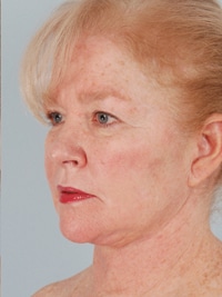 female jowl liposuction after