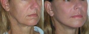 female jowl liposuction before and after