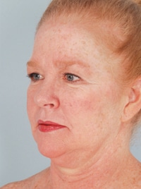 female jowl liposuction before