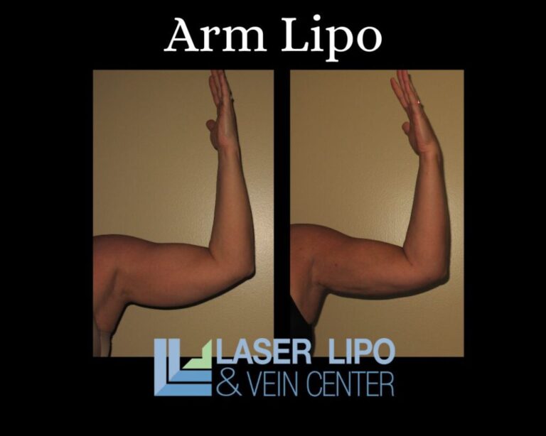 Arm Lipo St. Louis Laser Lipo and Vein2 1024x819