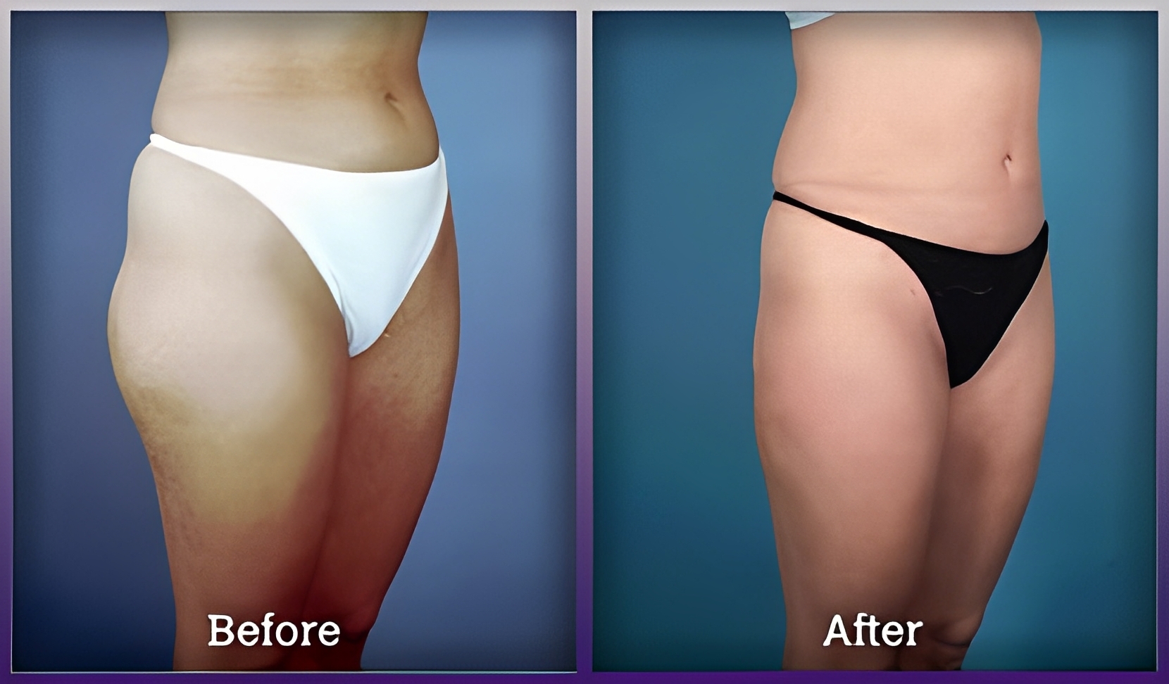 female anterior thigh liposuction before and after(1)