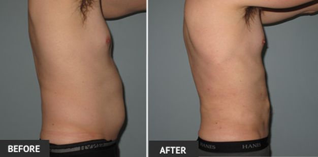 lipo ba91