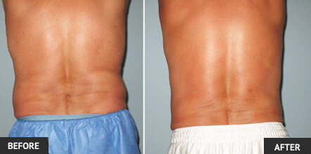 manback