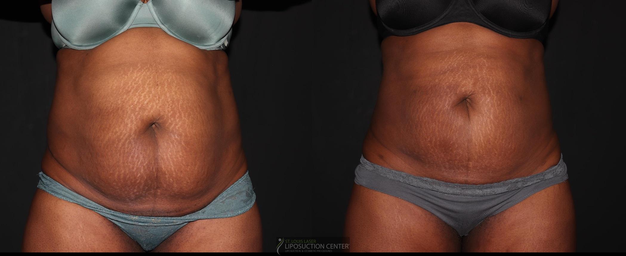 Before and After Image: Lipo 360 - front