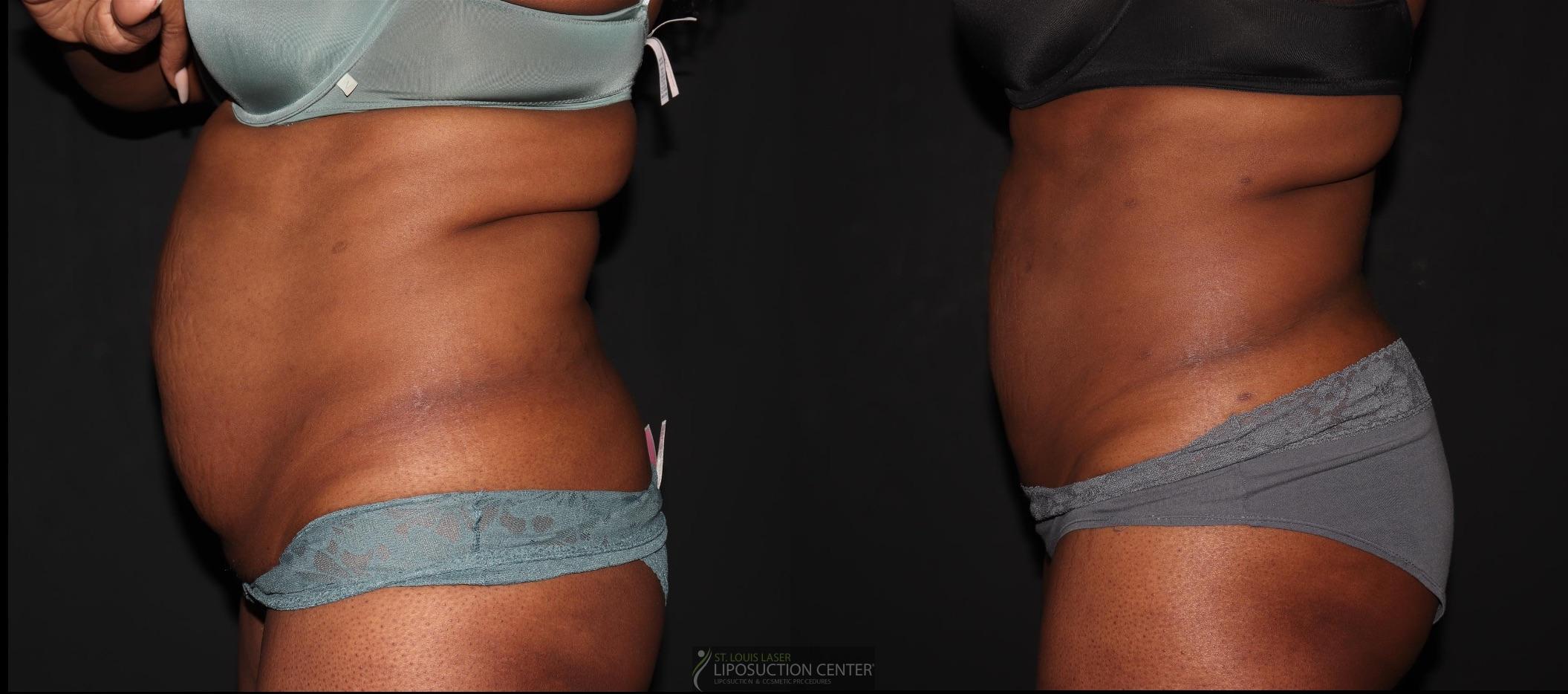 Before and After Image: Lipo 360 - left-side