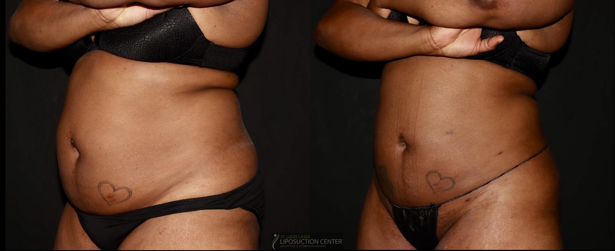 Before and After Image: Lipo 360 - left-front-oblique