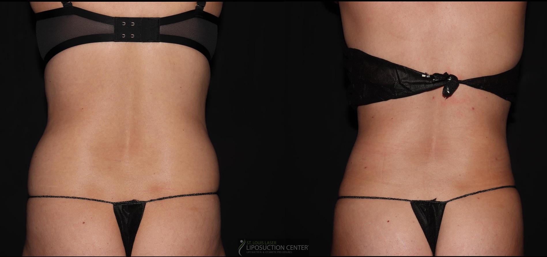Before and After Image: Lipo 360 - back