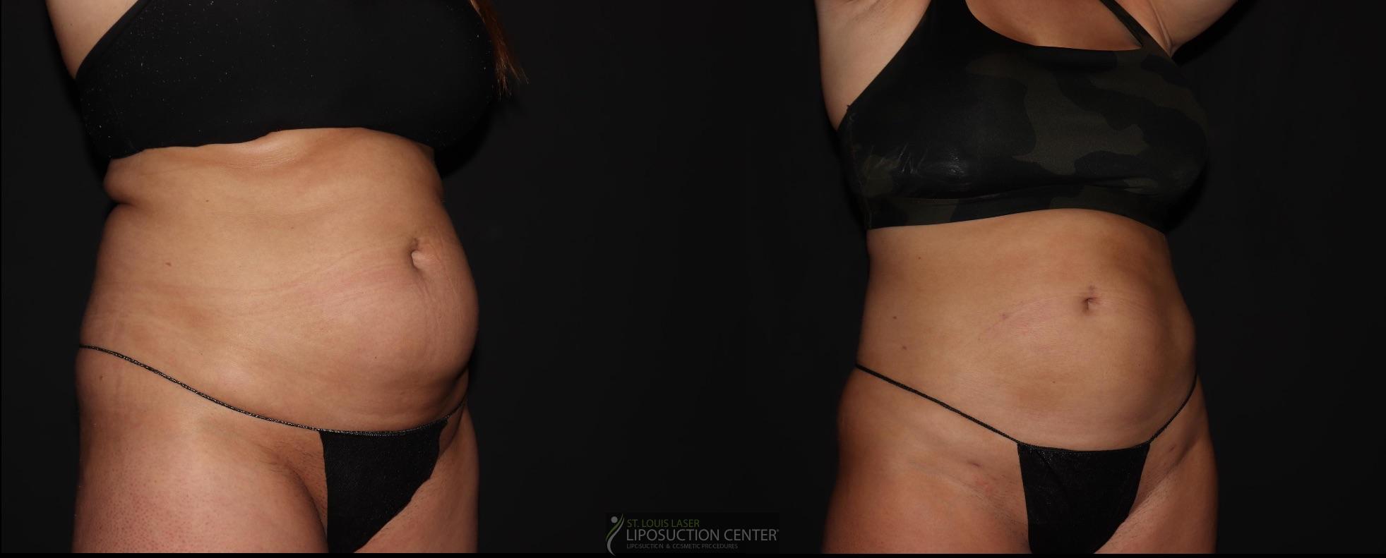 Before and After Image: Lipo 360 - right-front-oblique