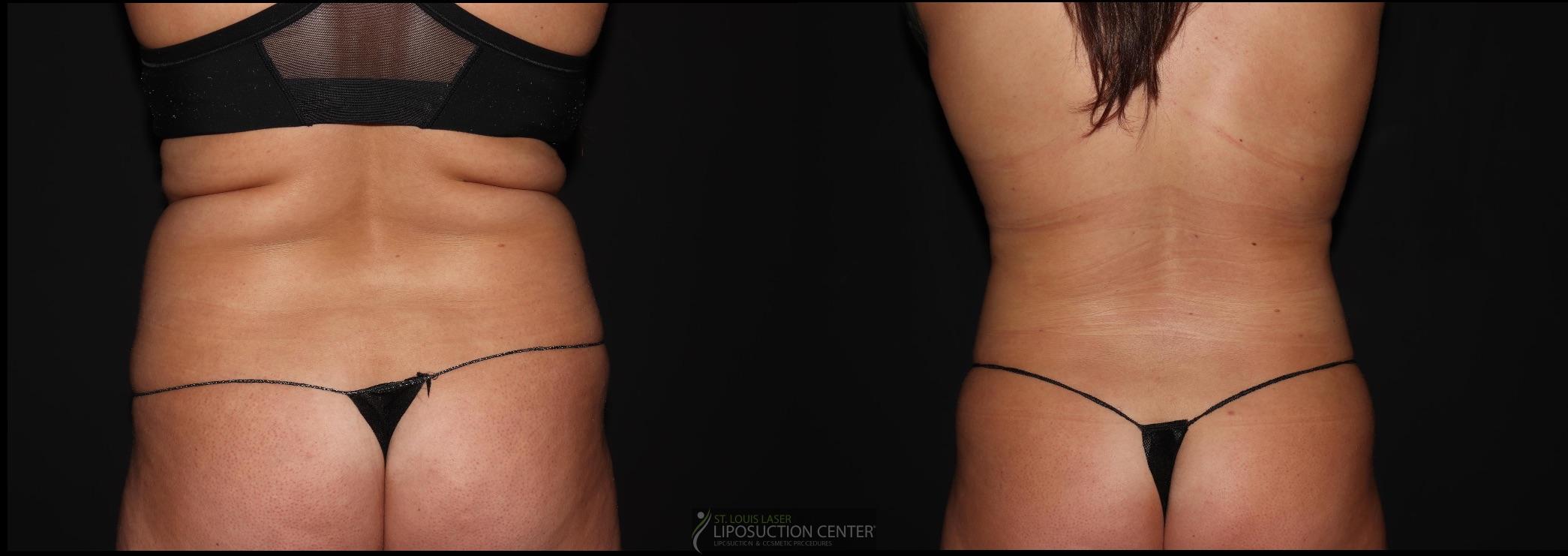 Before and After Image: Lipo 360 - back