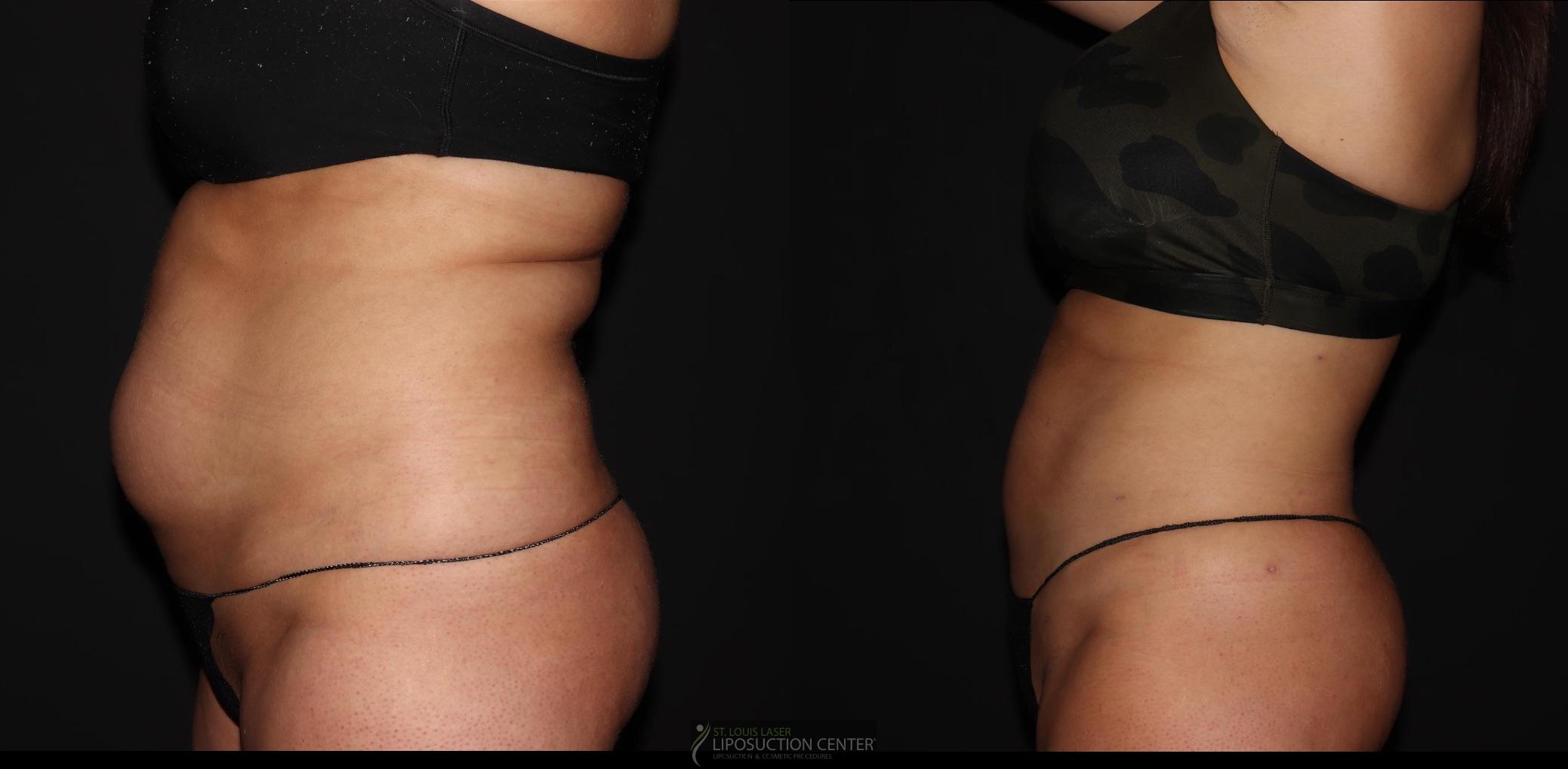 Before and After Image: Lipo 360 - left-side