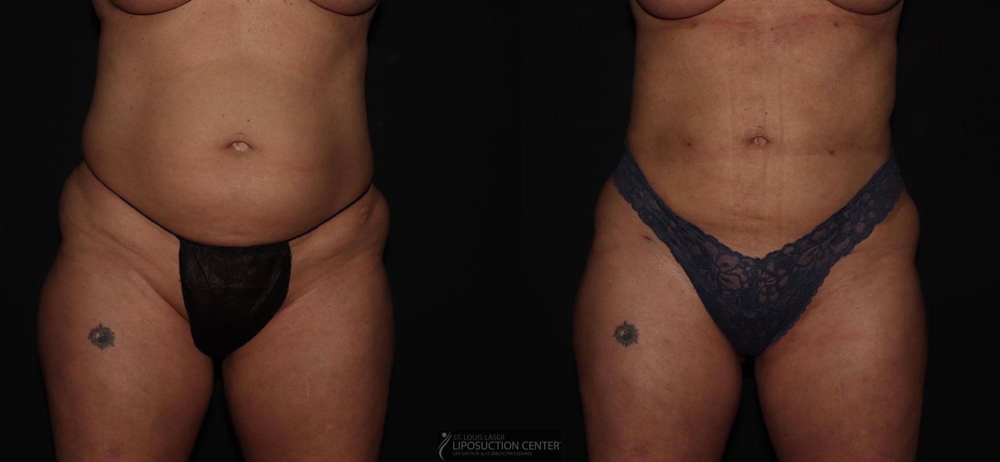 Before and After Image: Lipo 360 - front