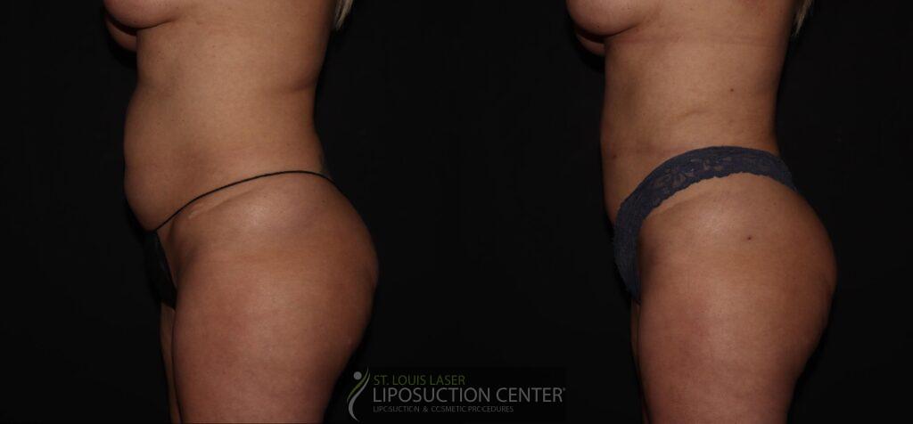 Lipo 360 c5 3 Lipo 360 c5 3