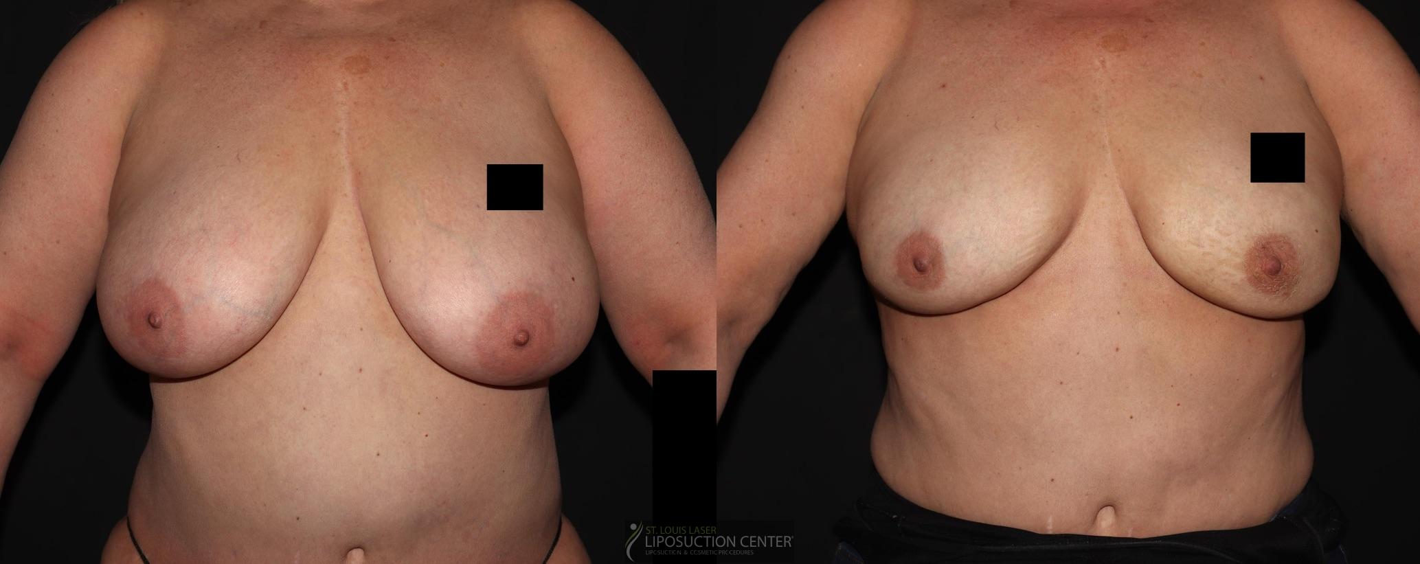 Before and After Image: Lipo-Renuvion to breast - front