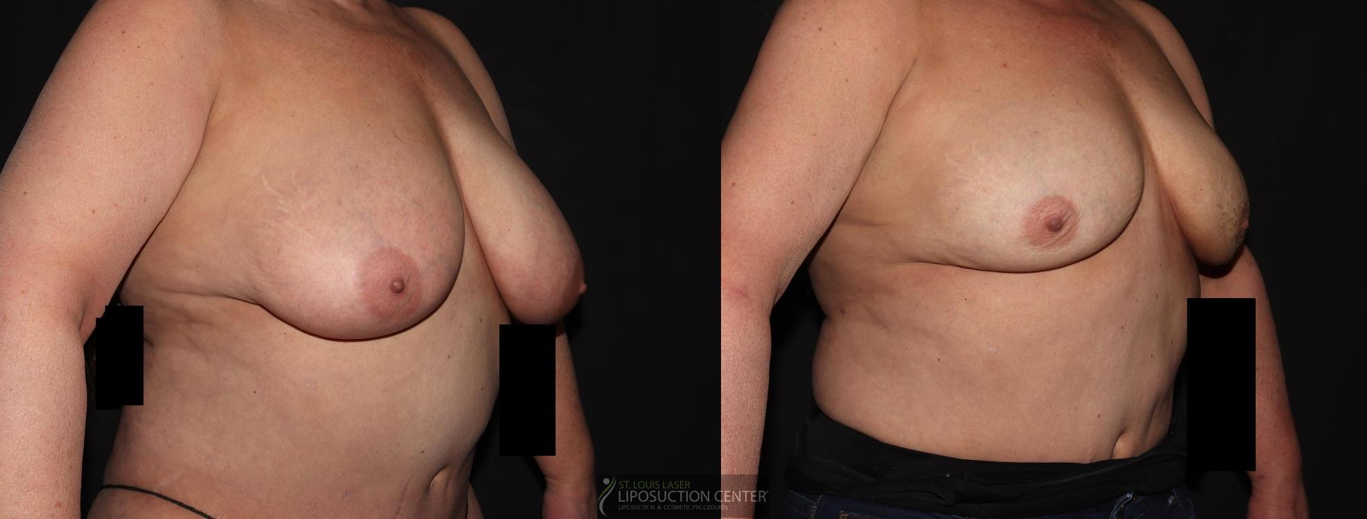 Before and After Image: Lipo-Renuvion to breast - right-front-oblique