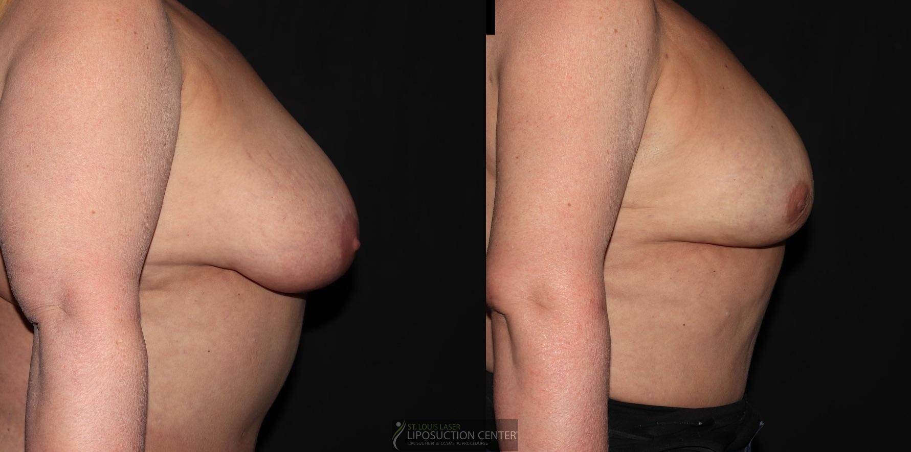 Before and After Image: Lipo-Renuvion to breast - right-side