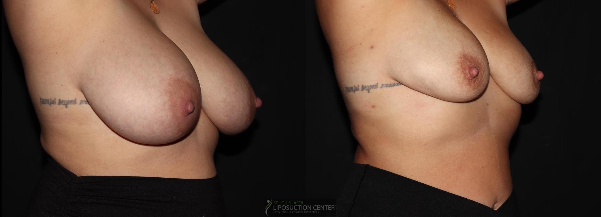 Before and After Image: Lipo-Renuvion to breast - right-front-oblique