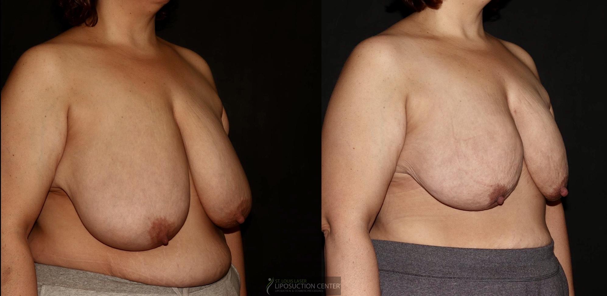 Before and After Image: Lipo-Renuvion to breast - right-front-oblique