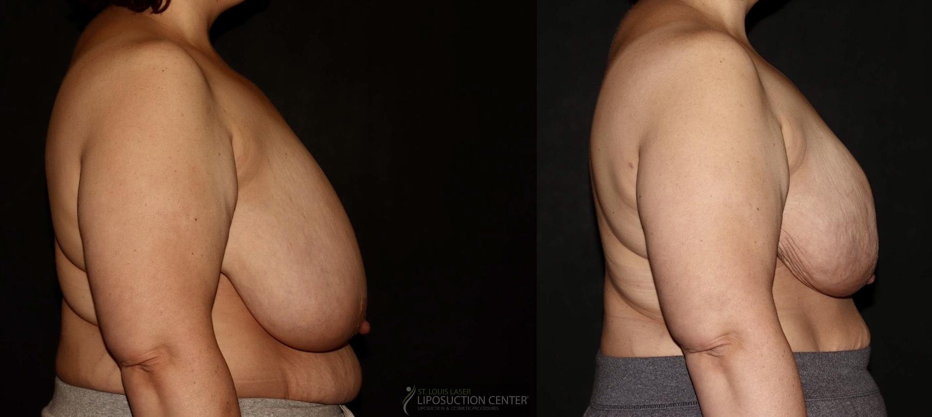 Before and After Image: Lipo-Renuvion to breast - right-side