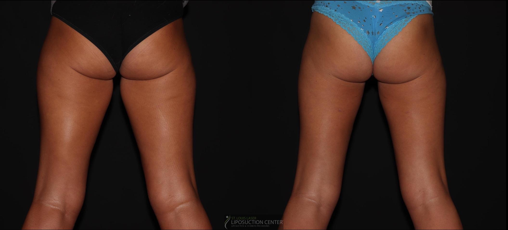 Before and After Image: Thighs - back