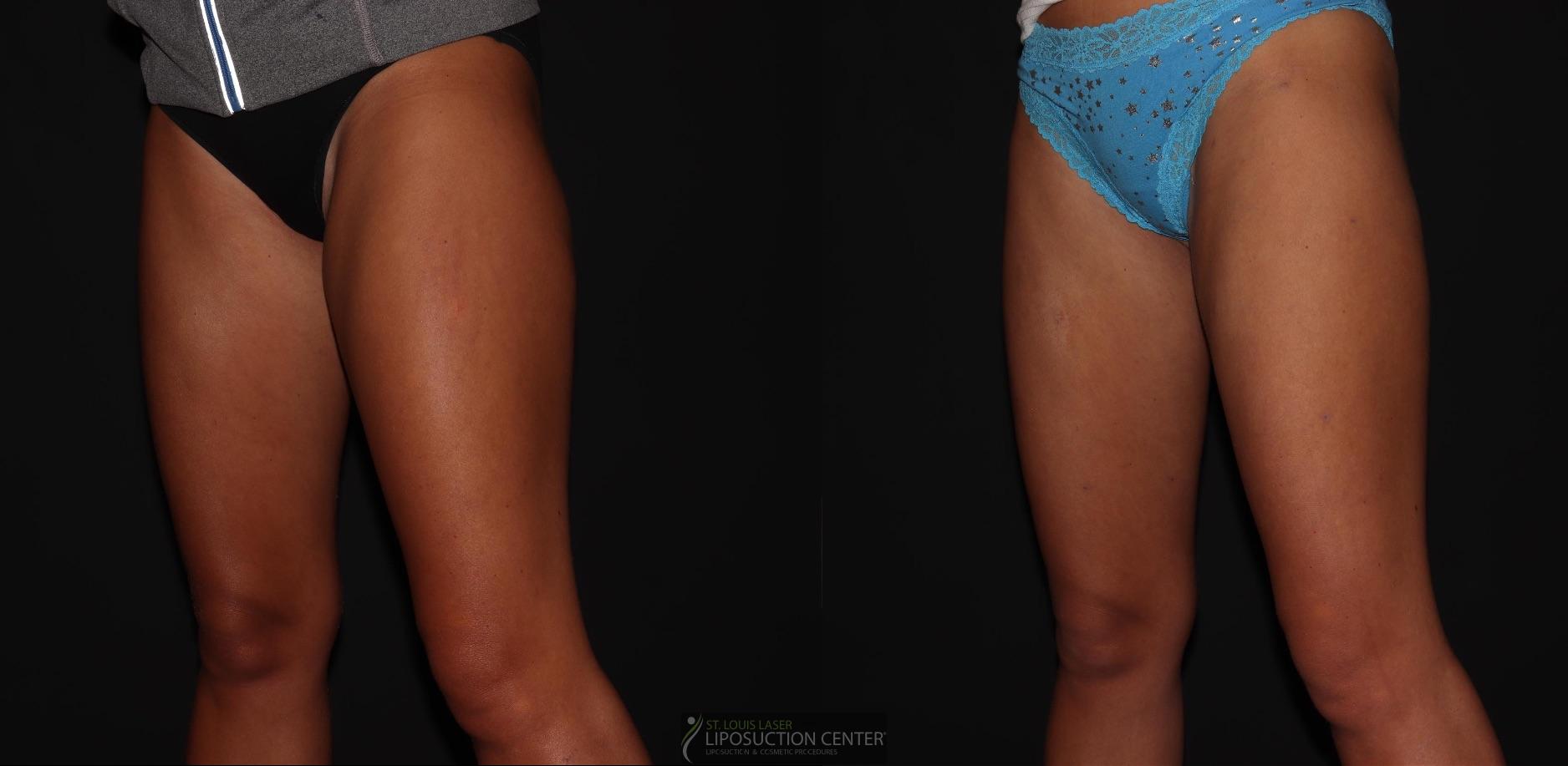 Before and After Image: Thighs - left-front-oblique