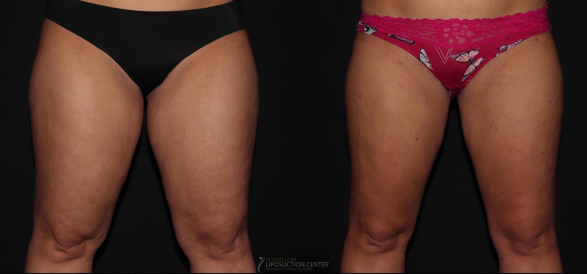 Before and After Image: Thighs - front