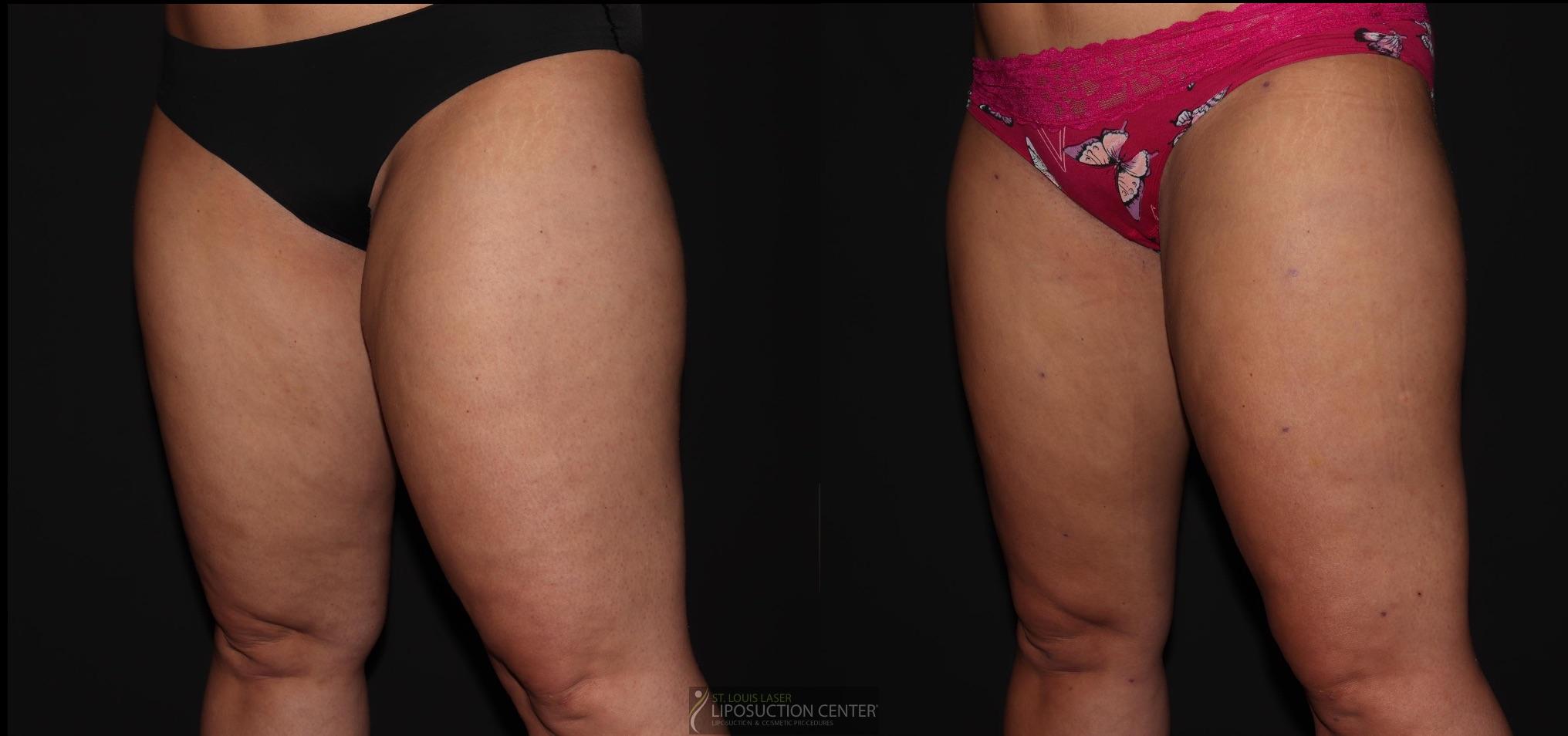 Before and After Image: Thighs - left-front-oblique