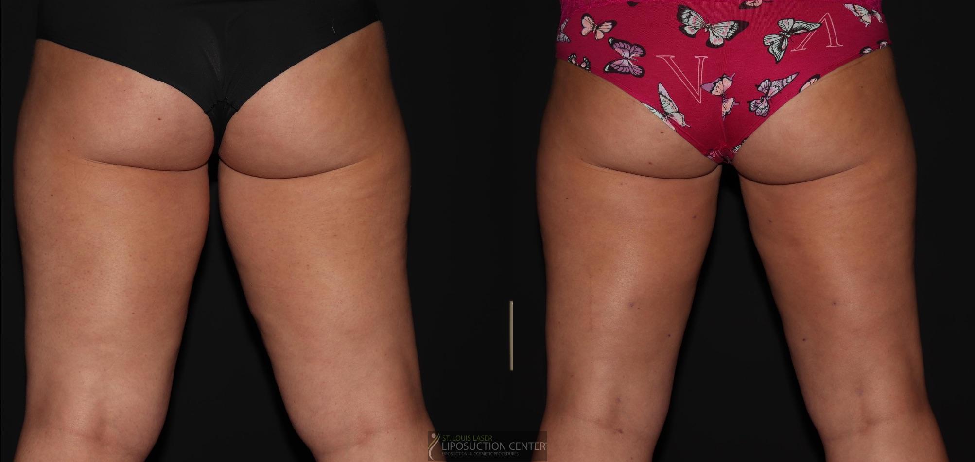 Before and After Image: Thighs - back